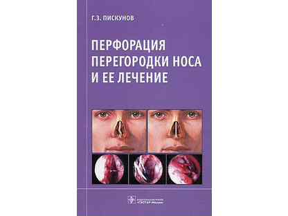 Перфорация носовой перегородки лечение. Перфорация носовой перегородки. Перфорация перегородки. Перфорированная перегородка носа. Перфорация перегородки носа пластика.